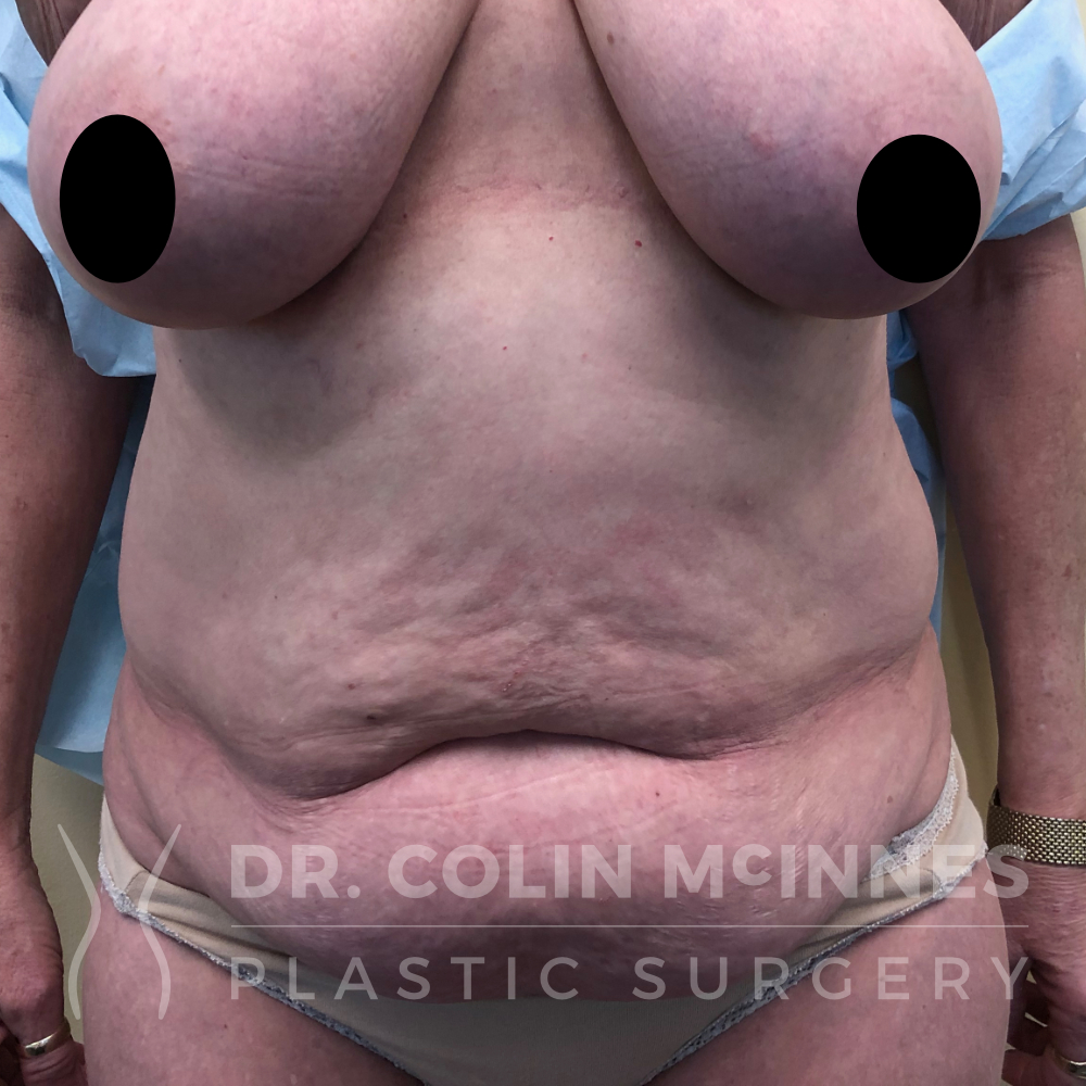 Breast reduction, abdominoplasty & liposuction - BEFORE